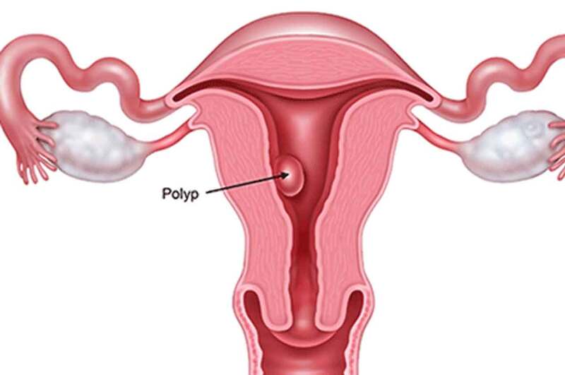  Polyp cổ tử cung là bệnh khá phổ biến