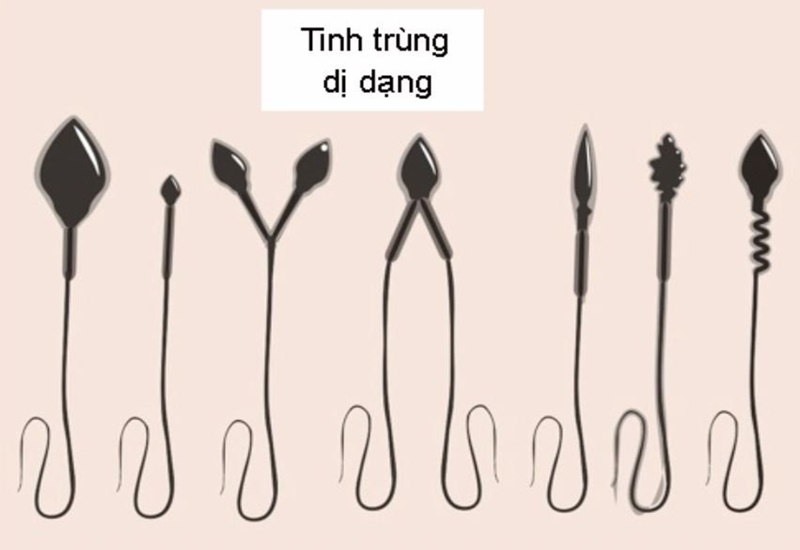 Tinh trùng dị dạng ảnh hưởng đến khả năng sinh sản của nam giới