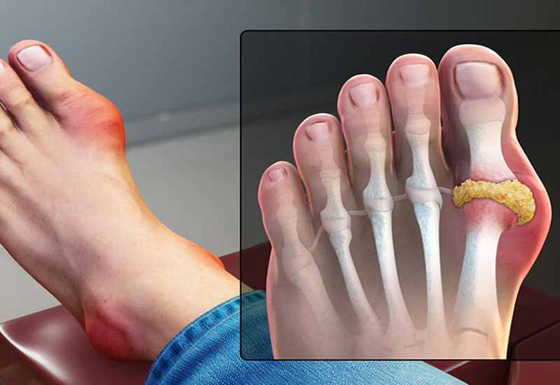 Hình ảnh bàn chân bị Gout