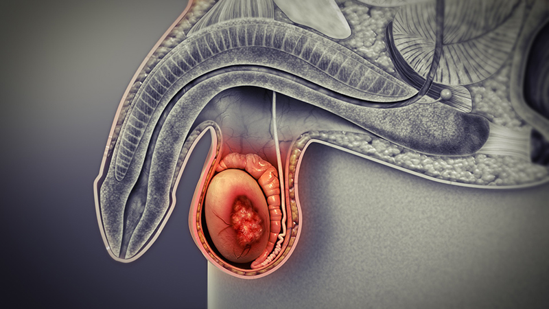 Ung thư tinh hoàn có chữa được không, đâu là nguyên nhân gây bệnh?