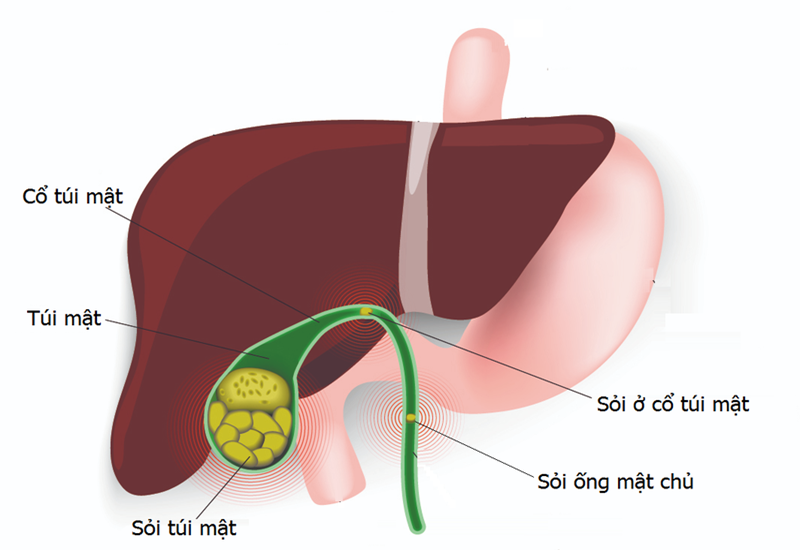 Sỏi túi mật là bệnh phổ biến ở Việt Nam