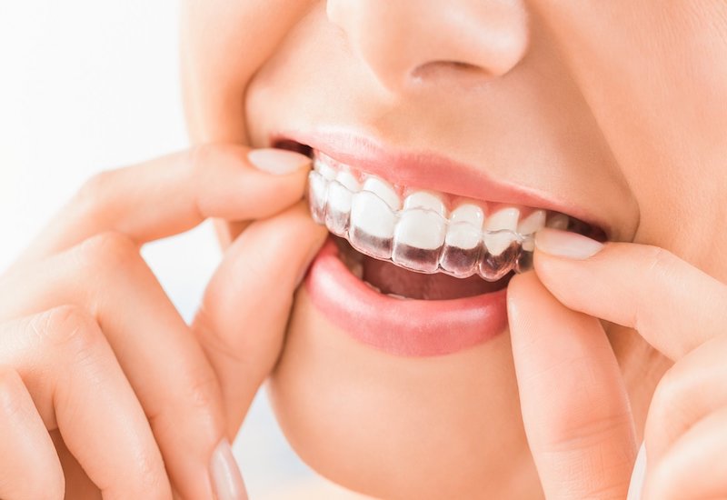 Chỉnh nha Invisalign đang ngày càng trở nên phổ biến