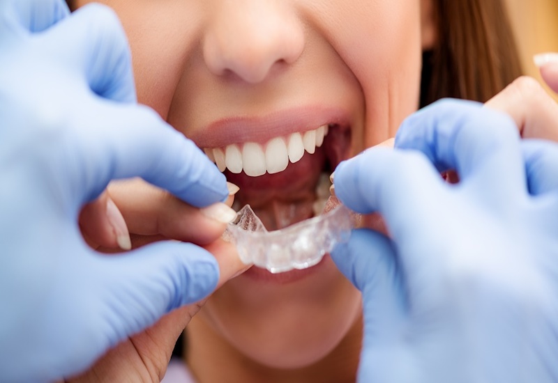 Chỉnh nha Invisalign có ưu điểm tiện lợi, dễ dàng tháo lắp và tính thẩm mỹ cao