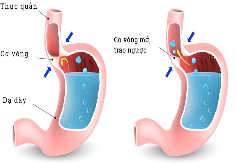 1. Hở Van Dạ Dày Là Gì?