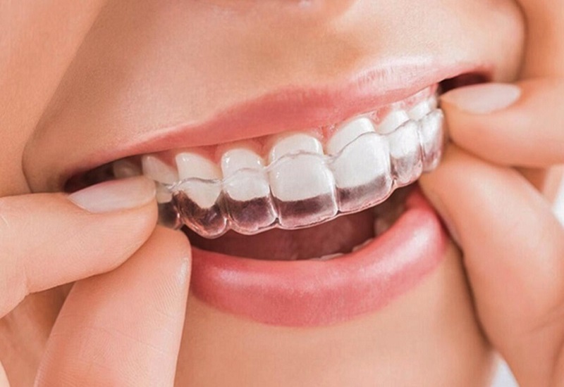 Chỉnh nha chính là phương pháp giúp khắc phục nhiều vấn đề về răng