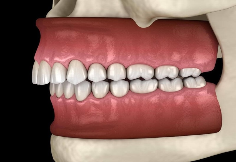 Hô răng là tình trạng hàm răng phía trên bị chìa ra quá mức so với hàm dưới