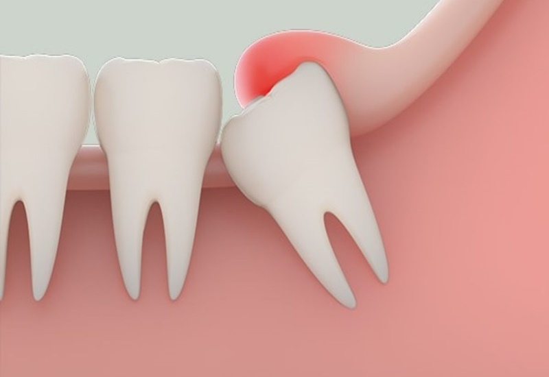 Răng khôn hay mọc lệch và mọc ở vị trí hiểm hóc