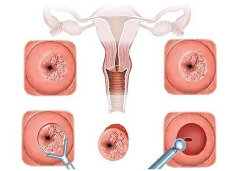 Viêm cổ tử cung mãn tính có thể gây ảnh hưởng nghiêm trọng đến sức khỏe sinh sản