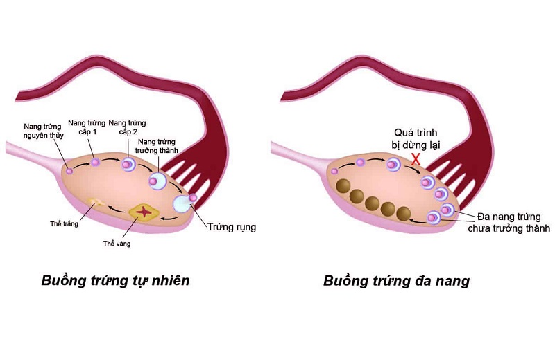 Mắc hội chứng buồng trứng đa nang là một trong những nguyên nhân khiến cho nữ giới không có kinh nguyệt