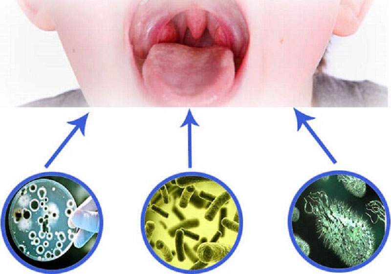 Sự tác động của virus gây nên nuốt nước bọt đau họng