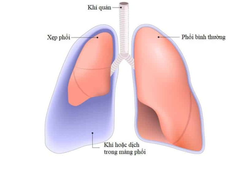 Xẹp phổi có thể dẫn đến một số biến chứng khó lường trước