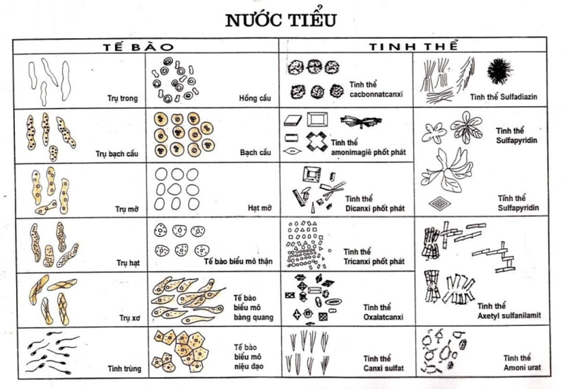 Trong nước tiểu có chứa một số thành phần hữu hình