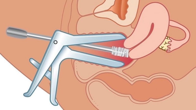 Khám vùng kín bằng mỏ vịt - một trong các bước không thể thiếu của quá trình khám phụ khoa