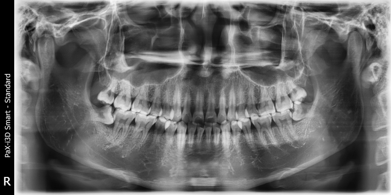 Bác sĩ cần kiểm tra cấu trúc, vị trí răng khôn trước khi nhổ