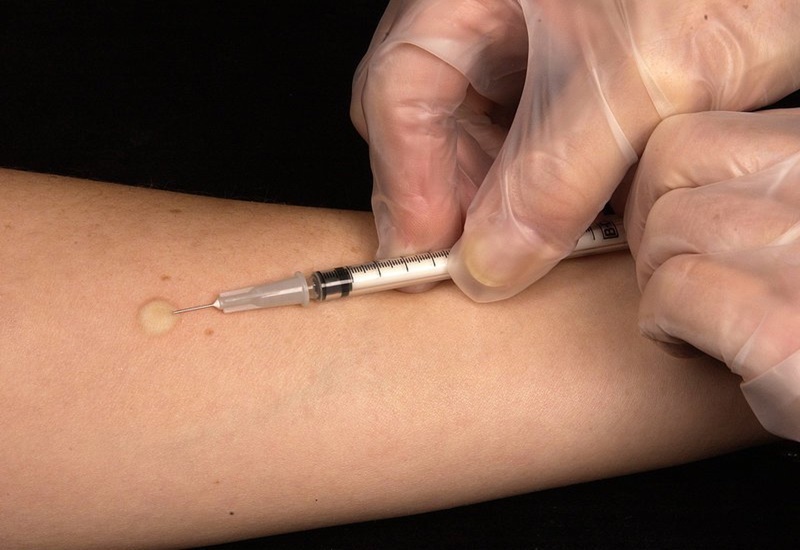 Test lẩy da để đánh giá tình trạng dị ứng