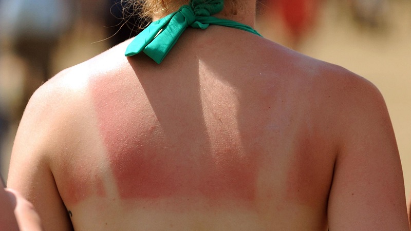 Làn da bị cháy nắng thường có hiện tượng đỏ và rát