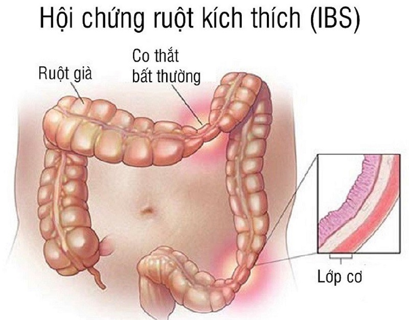 Thông tin chi tiết về hiện tượng bụng xì hơi nhiều