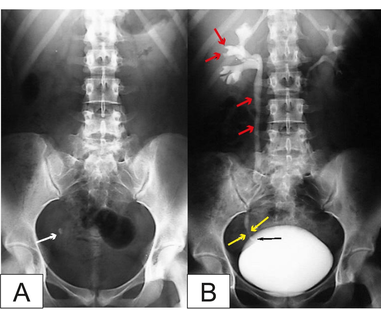Chụp X-quang niệu đồ tĩnh mạch là gì và những điều bạn cần biết?