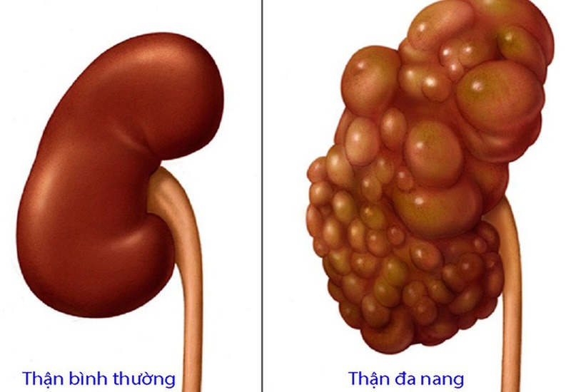 Bệnh có thể gây biến chứng nghiêm trọng