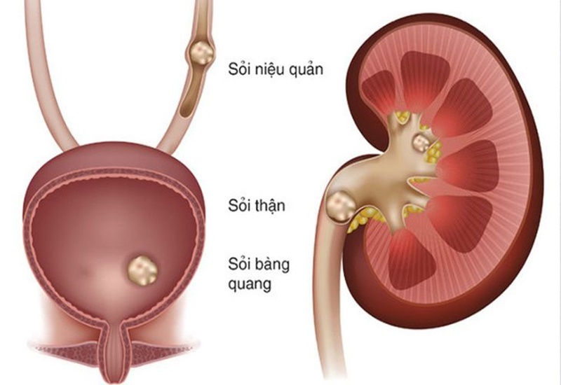 Sỏi niệu quản là bệnh thường gặp