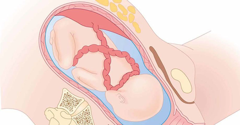 Do một số yếu tố mà dây rốn thắt nút lại gây ra những biến chứng trong quá trình mang thai