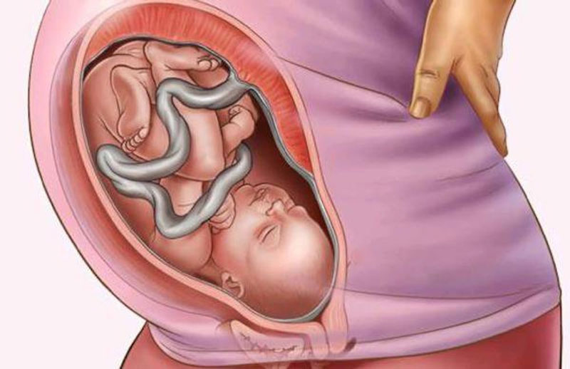 Việc xác định thời gian thai kỳ xuất hiện nút thắt dây rốn khá là khó