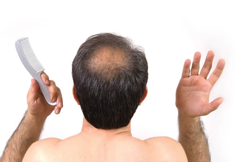 Top 5 cách trị hói đầu ở nữ nam tốt nhất giúp tóc mọc nhanh