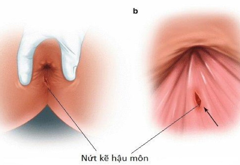 Nứt hậu môn dẫn đến viêm nhiễm