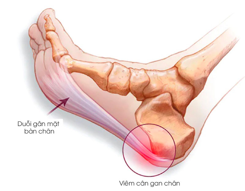 Bệnh lý cân gan chân là gì?