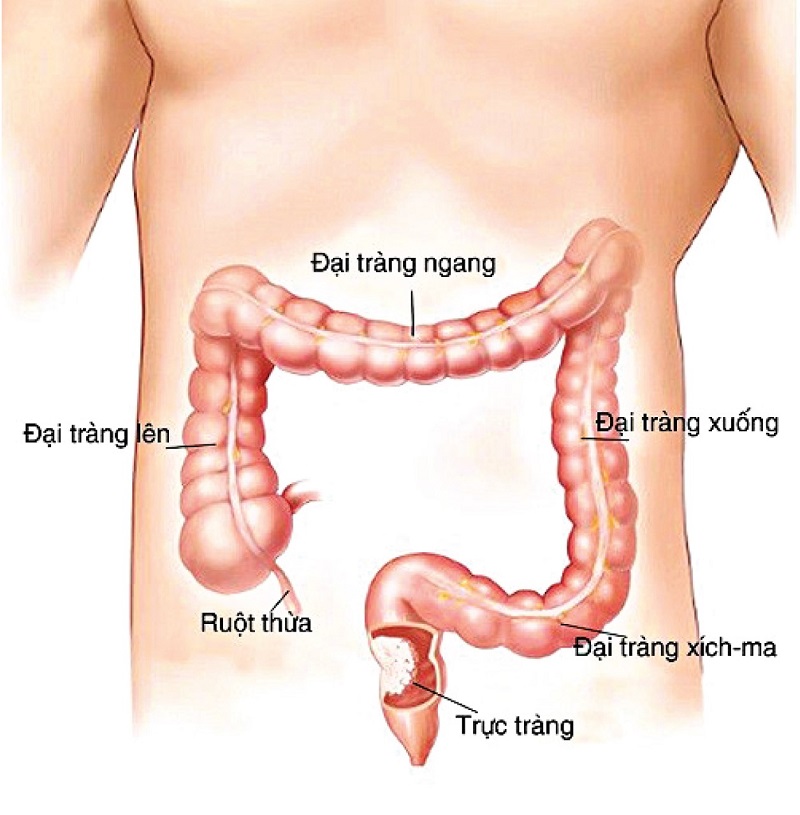 III. Phương Pháp Phòng Ngừa và Điều Trị