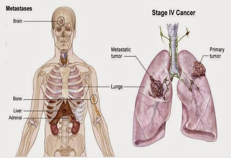 Thông Tin Về Ung Thư Phổi Di Căn Xương
