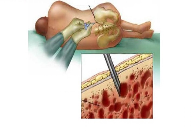 Sinh thiết tủy xương thường được áp dụng với những bệnh nhân nghi ngờ ung thư máu