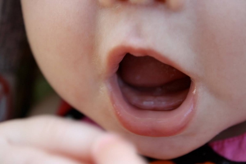 Mọc răng chậm xảy ra khi bé từ 12 - 13 tháng tuổi nhưng không mọc răng