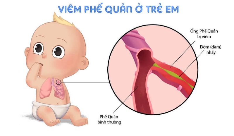 1. Giới thiệu về viêm phế quản co thắt ở trẻ