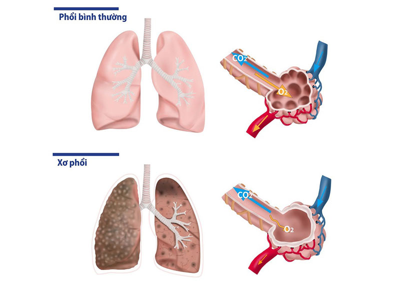 Triệu chứng xơ phổi là gì? Bệnh xơ phổi có nguy hiểm không?