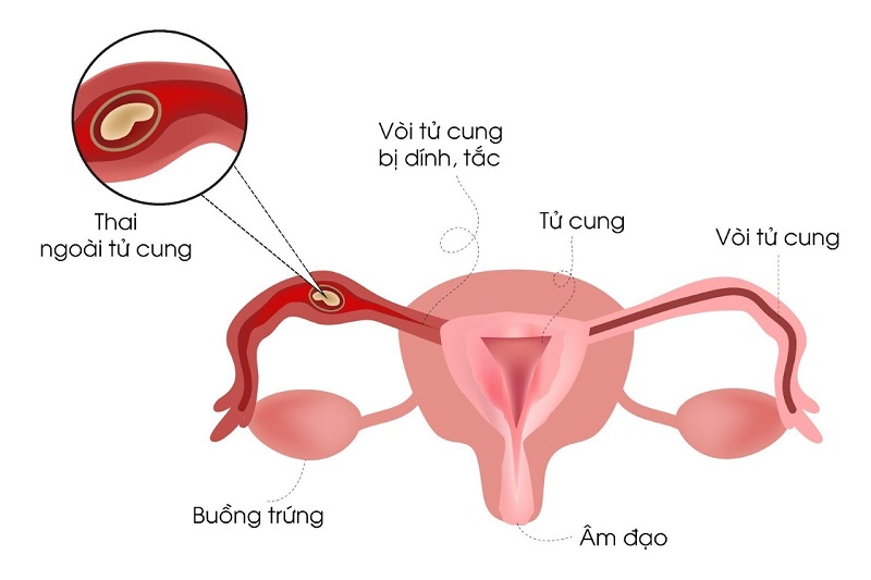 Không điều trị viêm phần phụ có thể khiến nữ giới mang thai ngoài tử cung