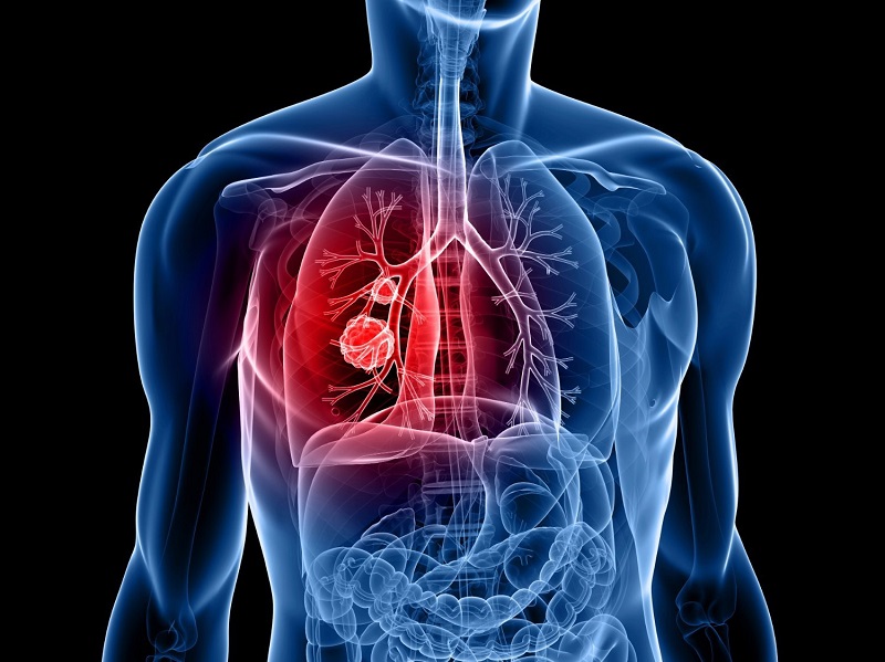 Ung thư phổi là 1 trong những nguyên nhân gây ra các cơn ho có máu