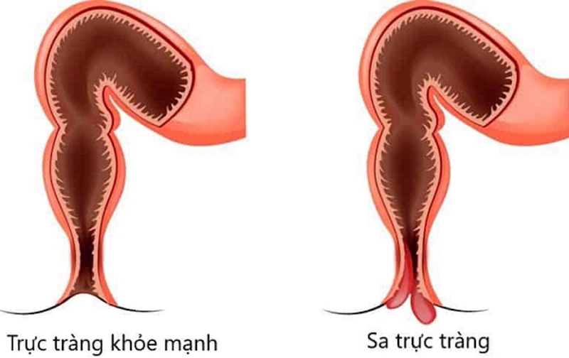 Tổng quan về chứng bệnh sa trực tràng