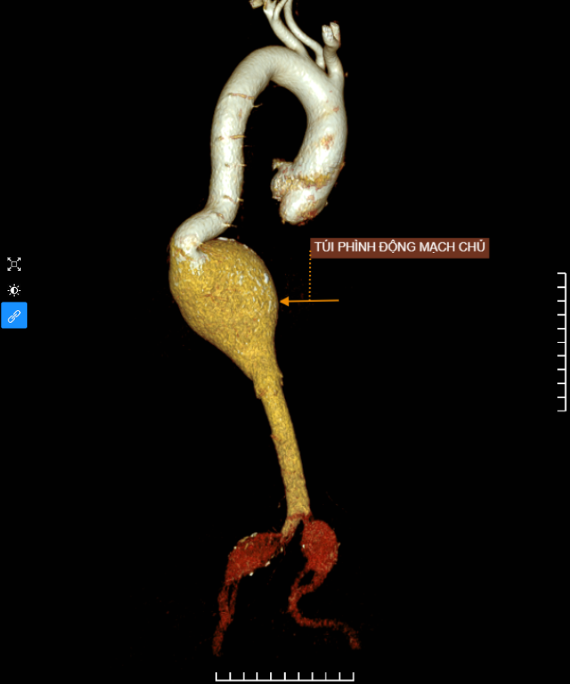  Kết quả chụp CT phát hiện hình ảnh túi phình hình thoi động mạch chủ ngực - bụng và động mạch chậu hai bên