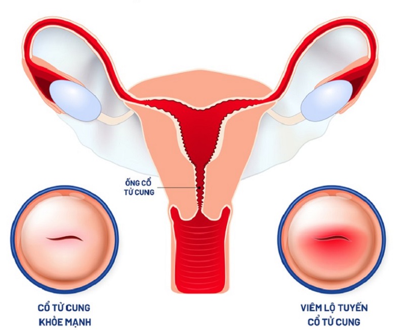 Cổ tử cung tái tạo là gì và mối liên hệ với bệnh viêm lộ tuyến cổ tử cung