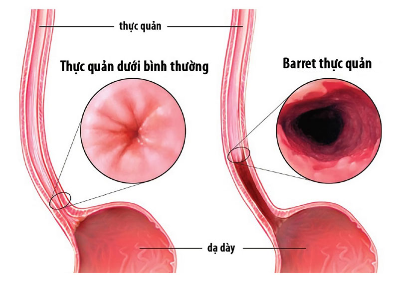 Barrett thực quản là một biến chứng thường gặp của bệnh trào ngược dạ dày