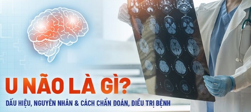 U não và những điều cần biết