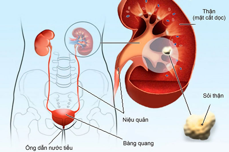 Sỏi thận là một trong bệnh lý dẫn đến triệu chứng tiểu nhiều lần ở nữ giới