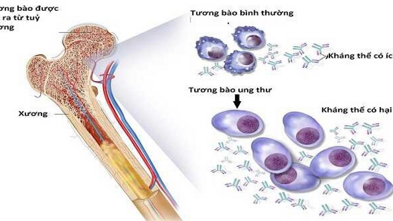 Bệnh đa u tủy xương hình thành do sự tăng sinh bất thường của tương bào