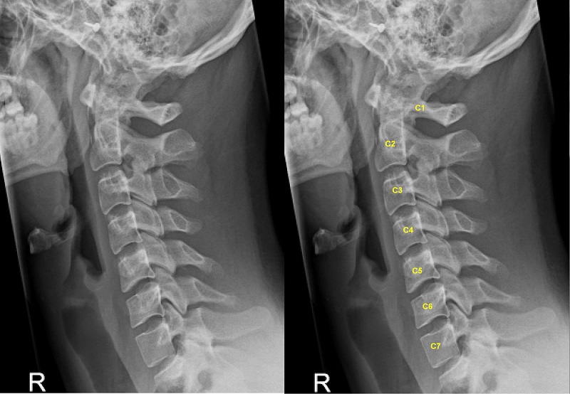 Bệnh thoái hóa đốt sống cổ có thể gây ra triệu chứng đau và cứng cổ