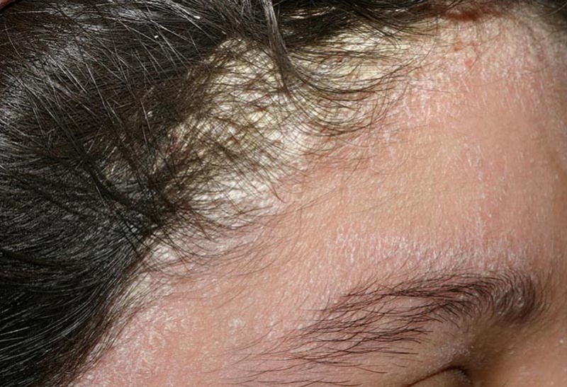 Nấm da đầu: Nguyên nhân do đâu? cách điều trị và phòng ngừa | Medlatec