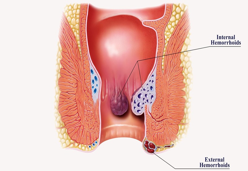 Bệnh trĩ có thể gây ra những biến chứng rất nguy hiểm