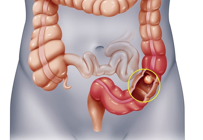 Bệnh trĩ có thể gây ung thư trực tràng nếu không điều trị sớm