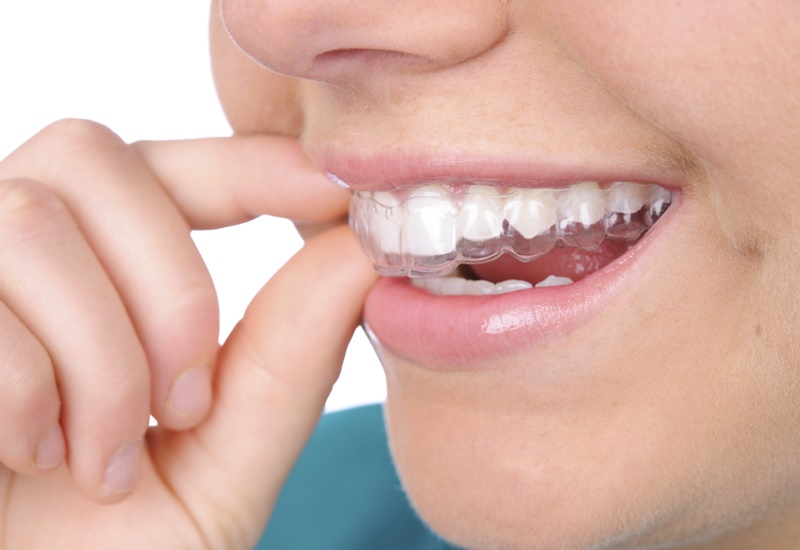 Ưu nhược điểm của máng tẩy trắng răng và hướng dẫn cách sử dụng