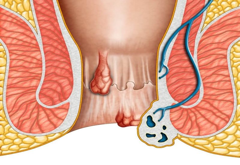 Mô phỏng búi trĩ nội, trĩ ngoại